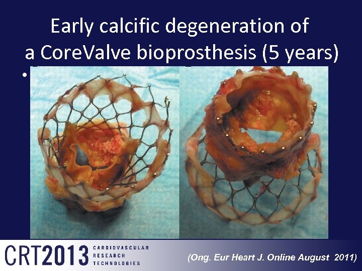 Early calcific degeneration of a Core. Valve bioprosthesis (5 years) • (Ong. Eur Heart