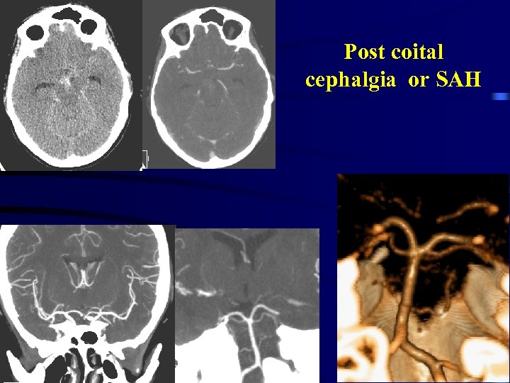 Post coital cephalgia or SAH 
