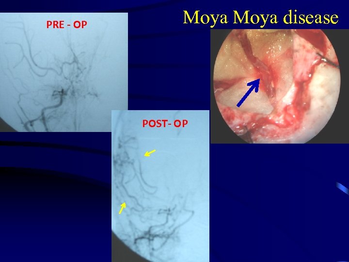 PRE - OP Moya disease POST- OP 