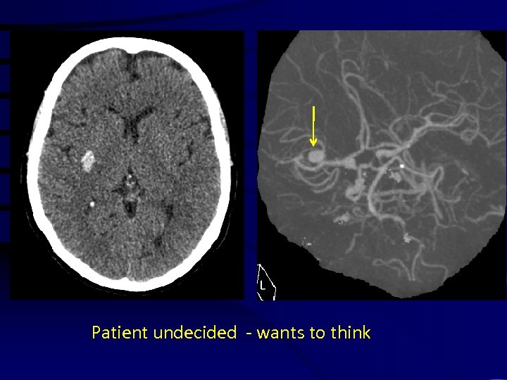 Patient undecided - wants to think 