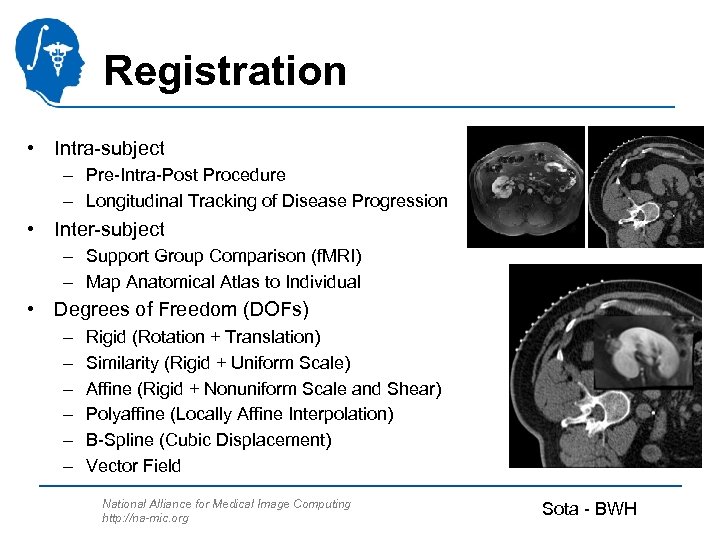 Registration • Intra-subject – Pre-Intra-Post Procedure – Longitudinal Tracking of Disease Progression • Inter-subject