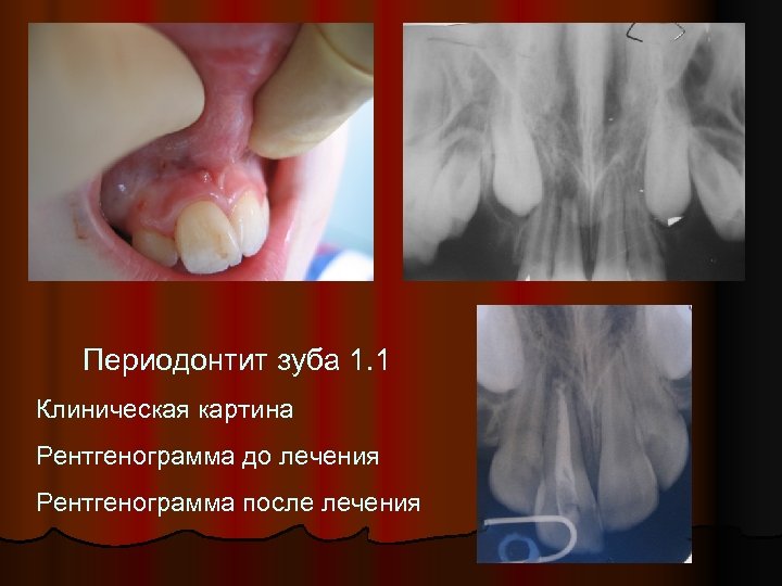 Периодонтит зуба 1. 1 Клиническая картина Рентгенограмма до лечения Рентгенограмма после лечения 