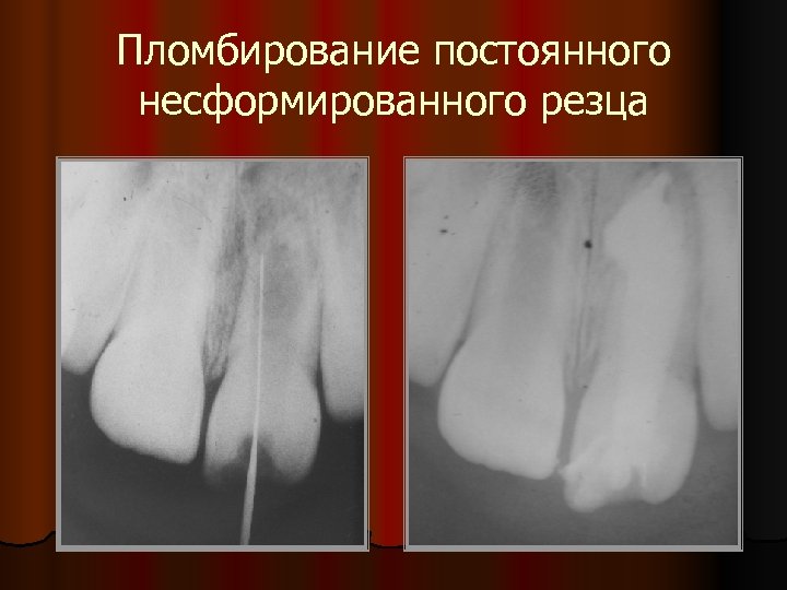 Пломбирование постоянного несформированного резца 