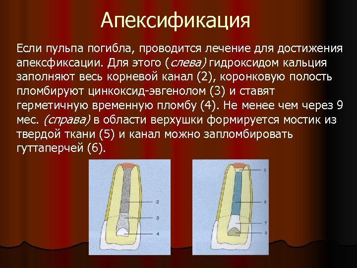 Апексификация Если пульпа погибла, проводится лечение для достижения апексфиксации. Для этого (слева) гидроксидом кальция