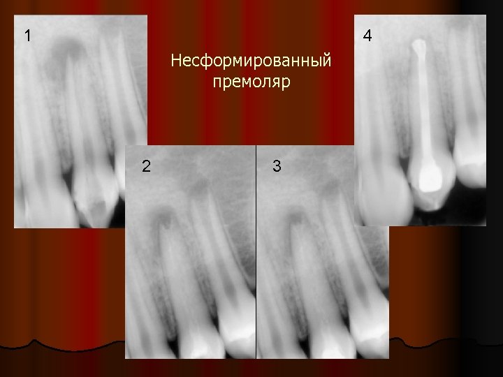 1 4 Несформированный премоляр 2 3 