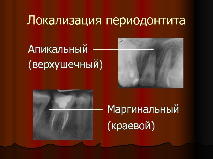 Локализация периодонтита Апикальный (верхушечный) Маргинальный (краевой) 