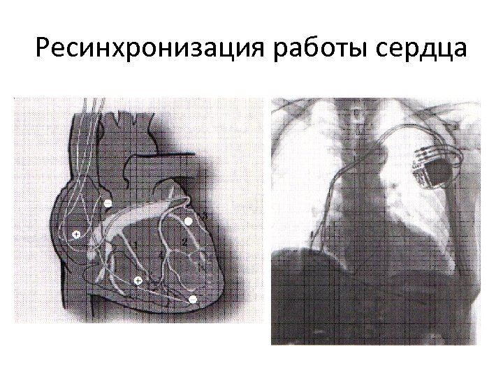 Ресинхронизация работы сердца 