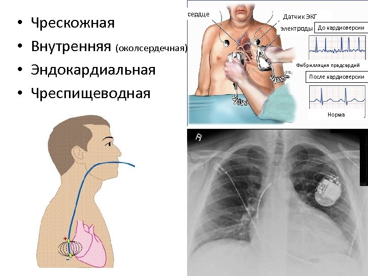  • • сердце Чрескожная Внутренняя (околсердечная) Эндокардиальная Чреспищеводная Датчик ЭКГ электроды До кардиоверсии