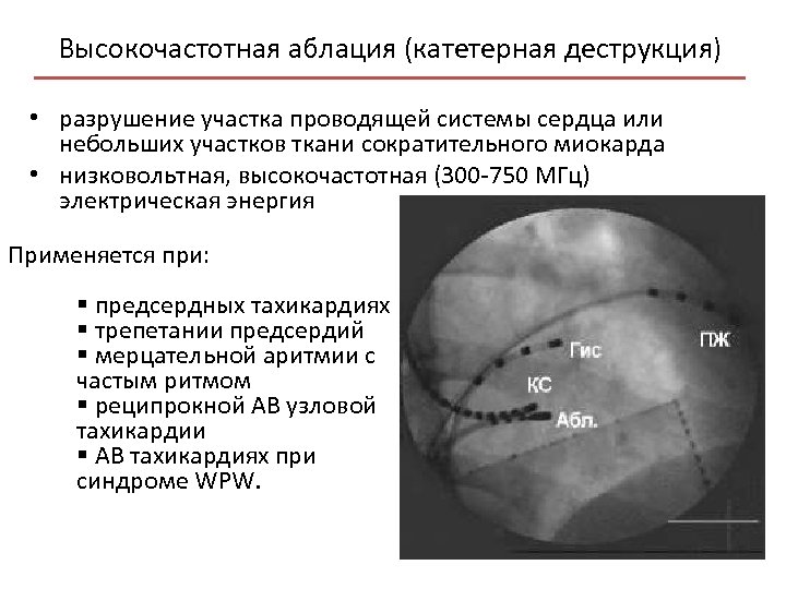 Высокочастотная аблация (катетерная деструкция) • разрушение участка проводящей системы сердца или небольших участков ткани