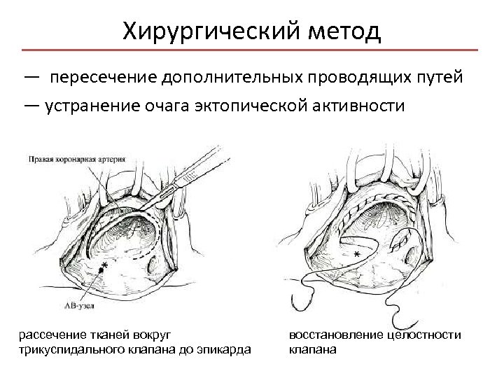 Хирургический метод — пересечение дополнительных проводящих путей — устранение очага эктопической активности рассечение тканей