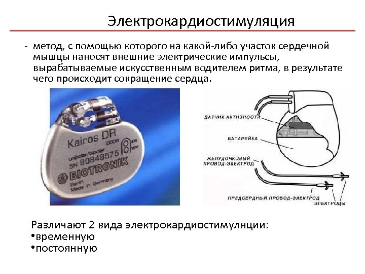 Электрокардиостимуляция - метод, с помощью которого на какой-либо участок сердечной мышцы наносят внешние электрические