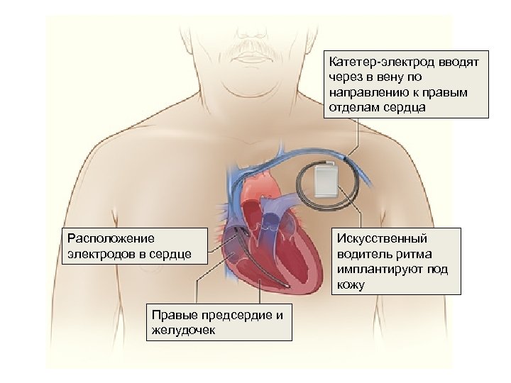 Катетер-электрод вводят через в вену по направлению к правым отделам сердца Расположение электродов в