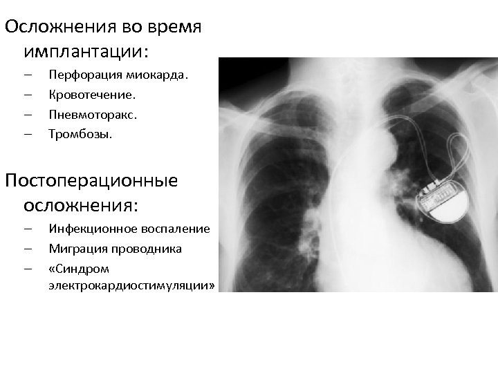 Осложнения во время имплантации: – – Перфорация миокарда. Кровотечение. Пневмоторакс. Тромбозы. Постоперационные осложнения: –