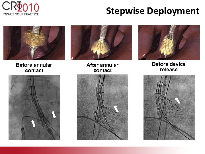 Stepwise Deployment Before annular contact After annular contact Before device release 