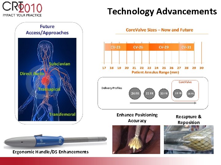 Technology Advancements Enhance Positioning Accuracy Ergonomic Handle/DS Enhancements Recapture & Reposition 