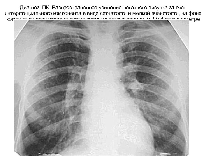 Компоненты легочного рисунка. Что такое интерстициальный компонент легочного рисунка. Легочный рисунок усилен. Усиление легочного рисунка за счет интерстициального компонента. Усиление легочного рисунка.