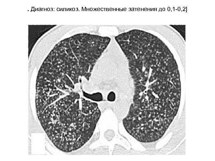 . Диагноз: силикоз. Множественные затенения до 0, 1 0, 2] 