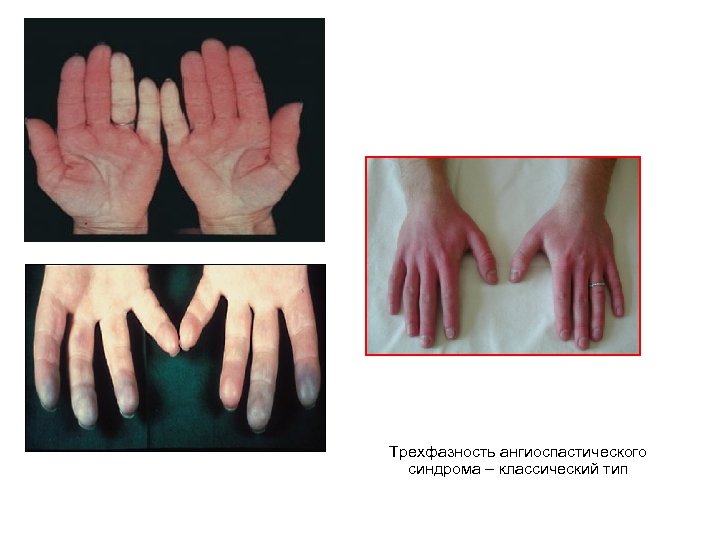 Трехфазность ангиоспастического синдрома – классический тип 
