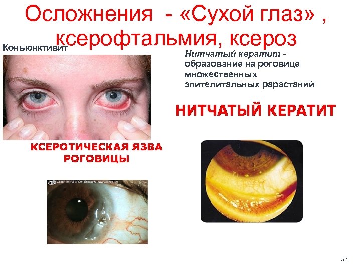 Осложнения «Сухой глаз» , ксерофтальмия, ксероз Коньюнктивит Нитчатый кератит - образование на роговице множественных