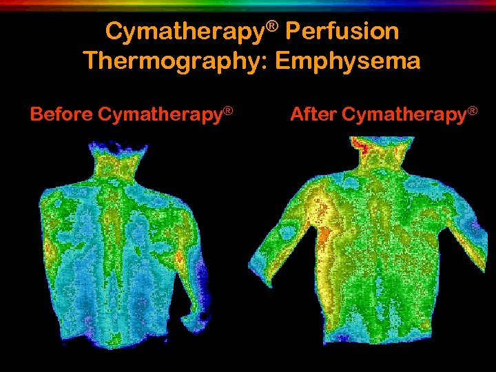 Cymatherapy® Perfusion Thermography: Emphysema Before Cymatherapy® After Cymatherapy® 