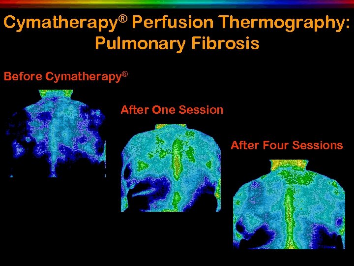 Cymatherapy® Perfusion Thermography: Pulmonary Fibrosis Before Cymatherapy® After One Session After Four Sessions 