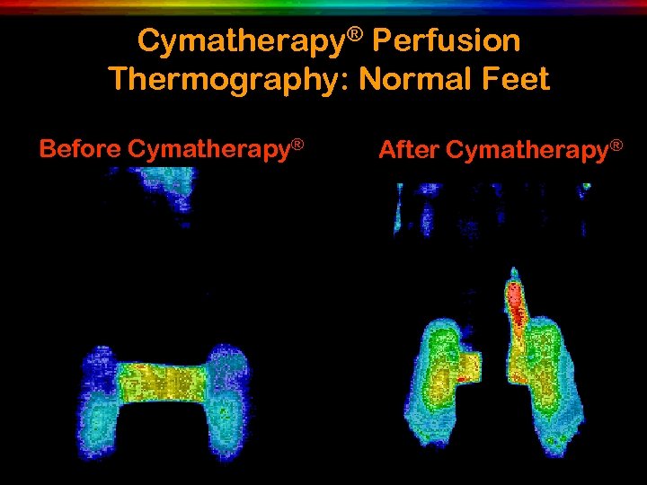 Cymatherapy® Perfusion Thermography: Normal Feet Before Cymatherapy® After Cymatherapy® 