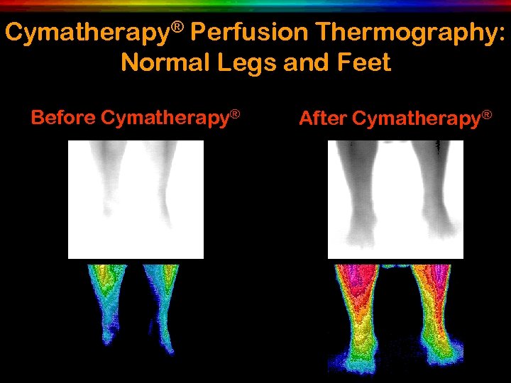 Cymatherapy® Perfusion Thermography: Normal Legs and Feet Before Cymatherapy® After Cymatherapy® 