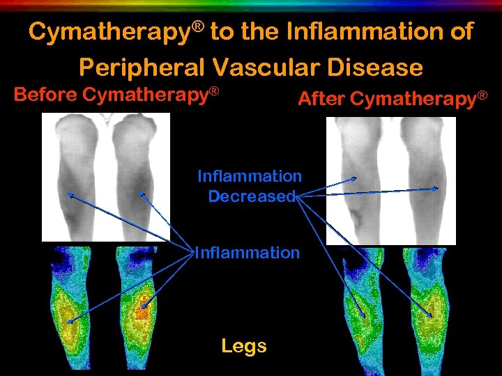 Cymatherapy® to the Inflammation of Peripheral Vascular Disease Before Cymatherapy® After Cymatherapy® Inflammation Decreased