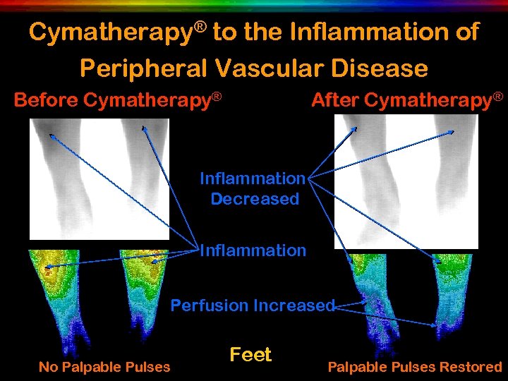 Cymatherapy® to the Inflammation of Peripheral Vascular Disease Before Cymatherapy® After Cymatherapy® Inflammation Decreased