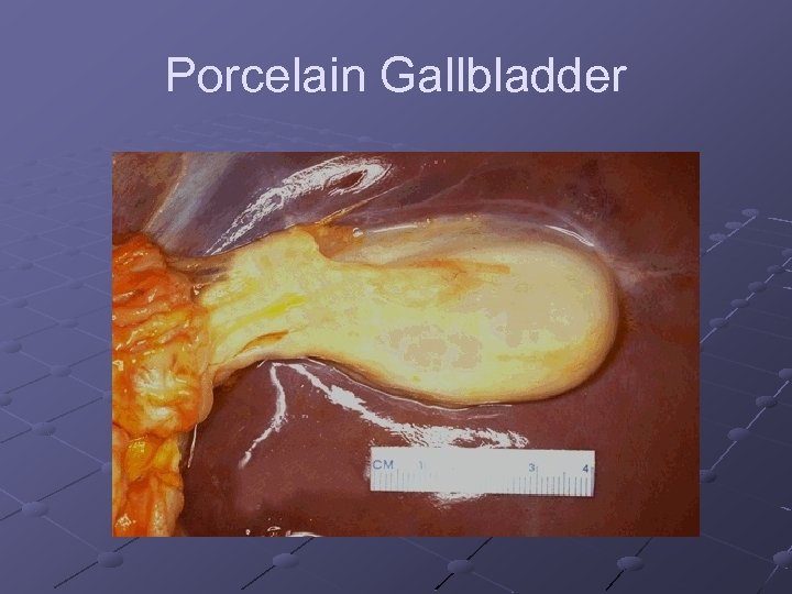 Porcelain Gallbladder 