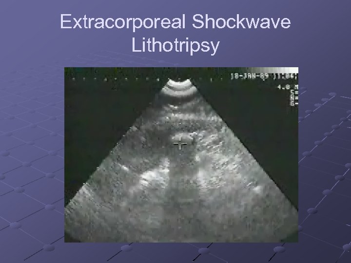 Extracorporeal Shockwave Lithotripsy 