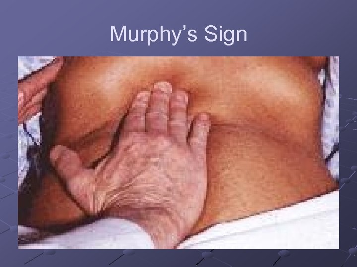 Murphy’s Sign 