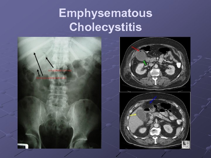 Emphysematous Cholecystitis 