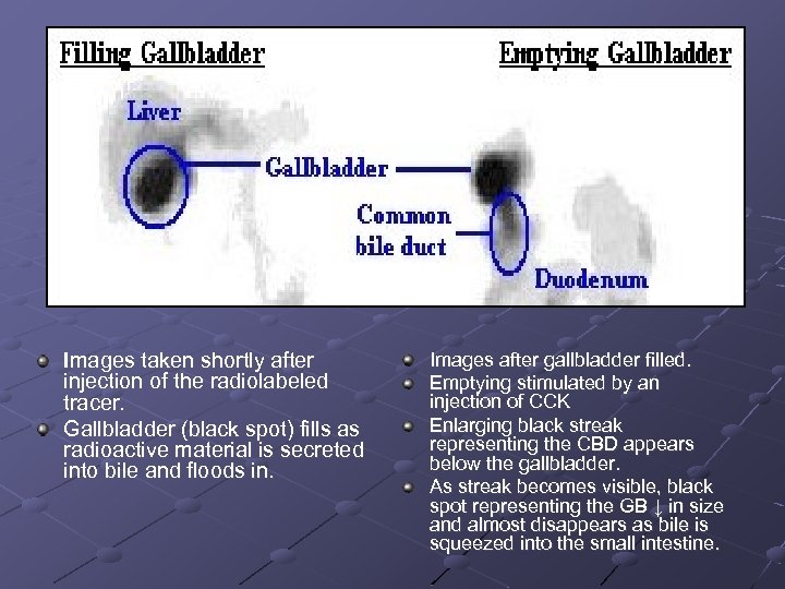 Images taken shortly after injection of the radiolabeled tracer. Gallbladder (black spot) fills as