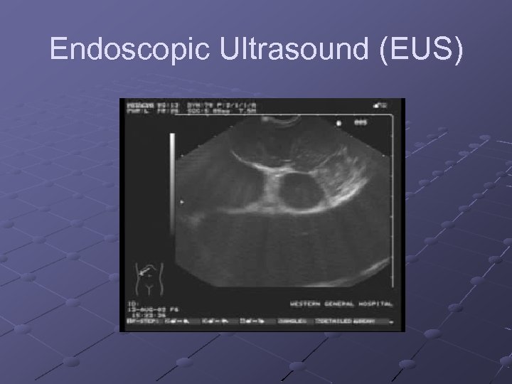 Endoscopic Ultrasound (EUS) 