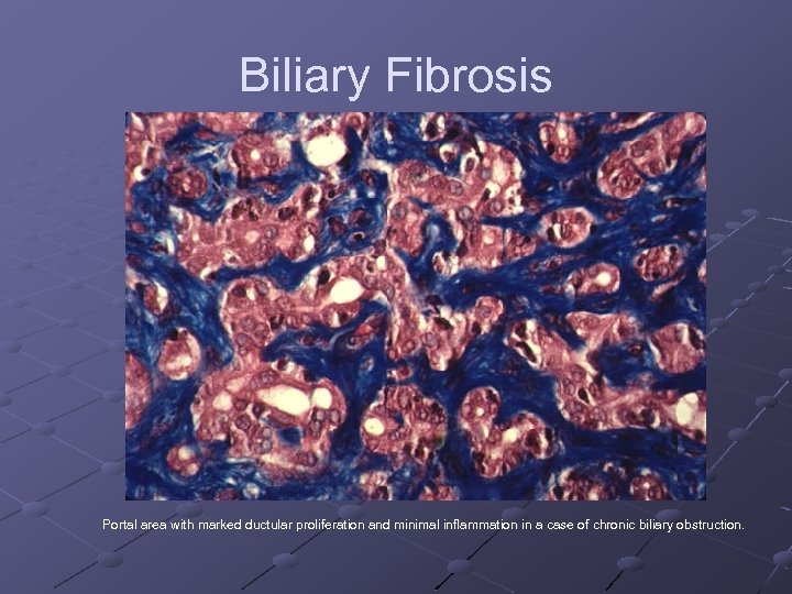 Biliary Fibrosis Portal area with marked ductular proliferation and minimal inflammation in a case