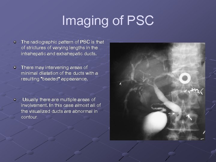 Imaging of PSC The radiographic pattern of PSC is that of strictures of varying