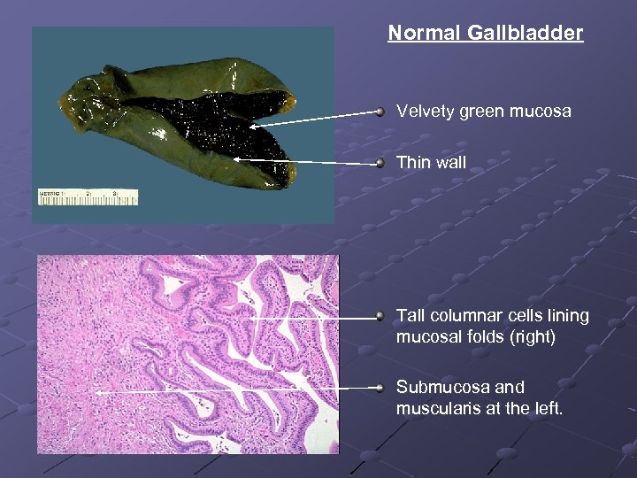Normal Gallbladder Velvety green mucosa Thin wall Tall columnar cells lining mucosal folds (right)
