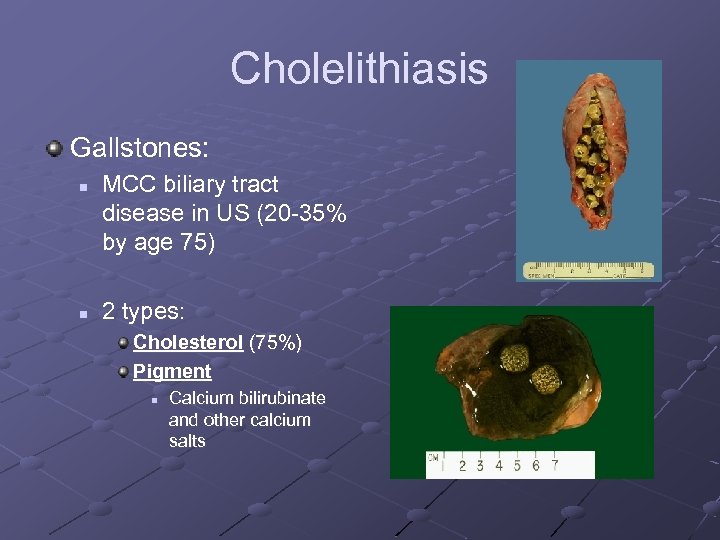 Cholelithiasis Gallstones: n n MCC biliary tract disease in US (20 -35% by age