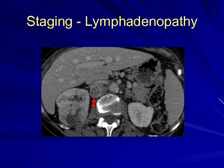 Staging - Lymphadenopathy 