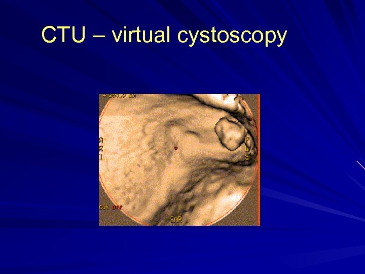 CTU – virtual cystoscopy 
