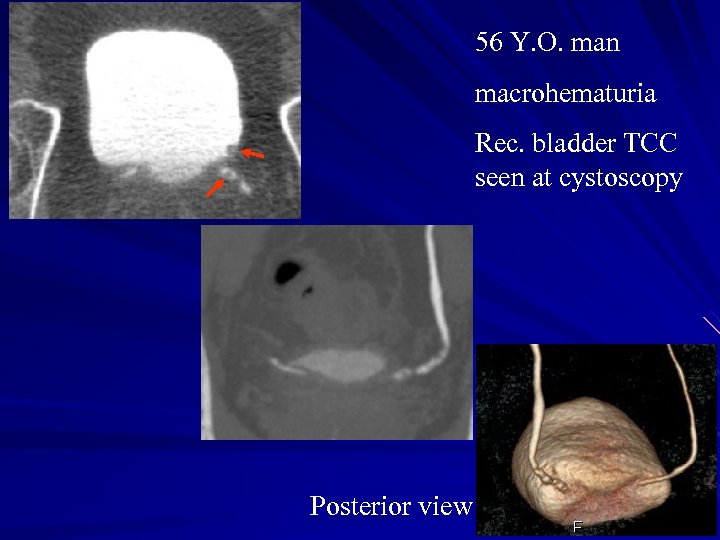 56 Y. O. man macrohematuria Rec. bladder TCC seen at cystoscopy Posterior view 