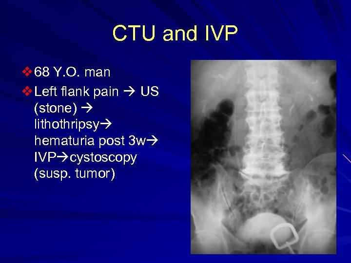 CTU and IVP v 68 Y. O. man v Left flank pain US (stone)