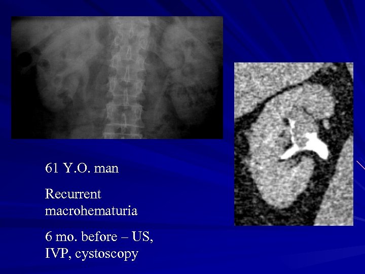 61 Y. O. man Recurrent macrohematuria 6 mo. before – US, IVP, cystoscopy 