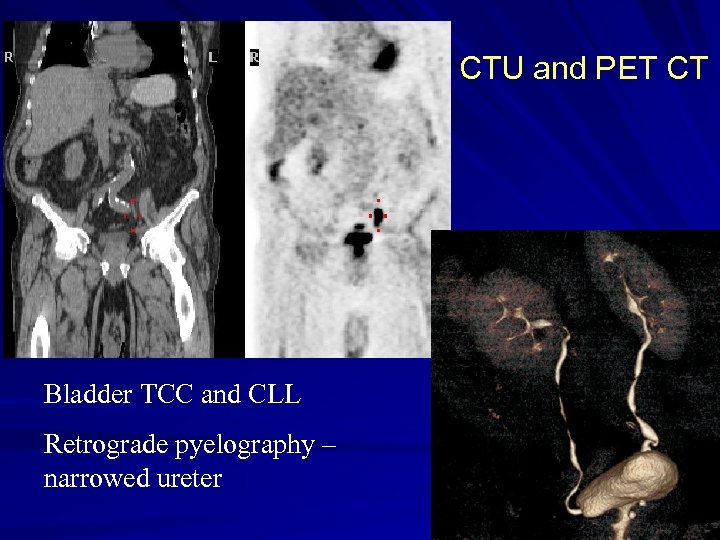 CTU and PET CT Bladder TCC and CLL Retrograde pyelography – narrowed ureter 
