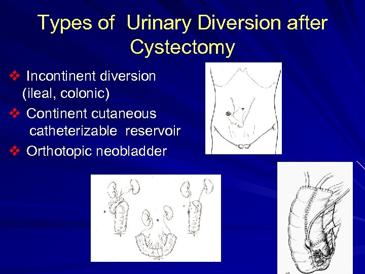 Types of Urinary Diversion after Cystectomy v Incontinent diversion (ileal, colonic) v Continent cutaneous