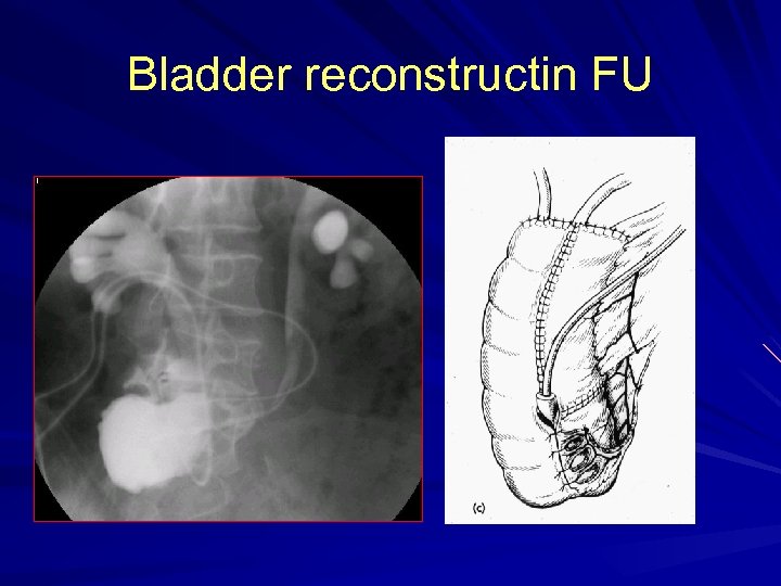 Bladder reconstructin FU 