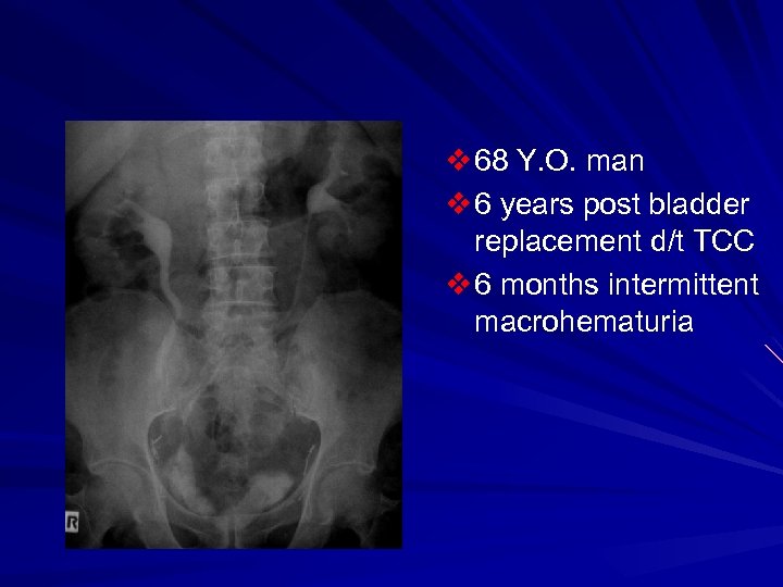 v 68 Y. O. man v 6 years post bladder replacement d/t TCC v