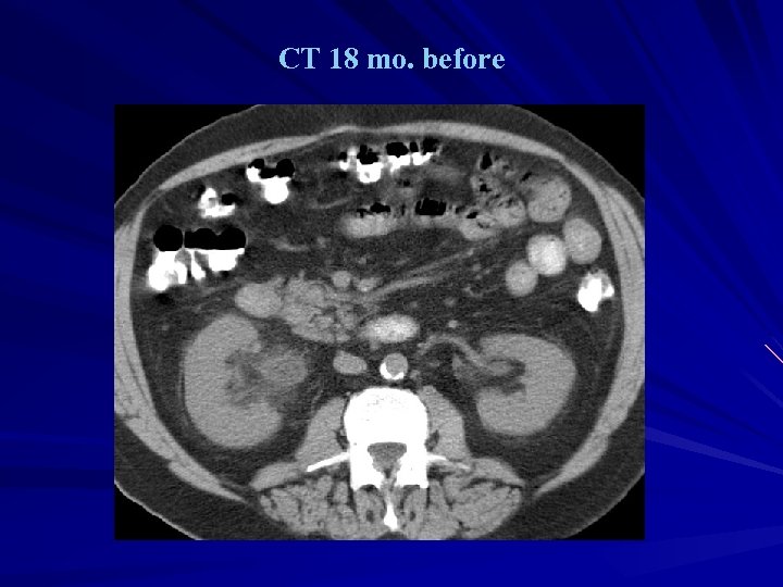 CT 18 mo. before 