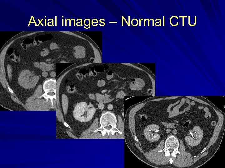 Axial images – Normal CTU 